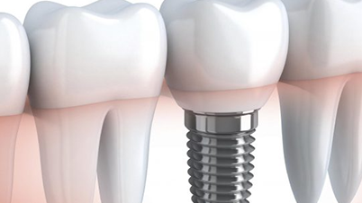 Implantes sem cortes